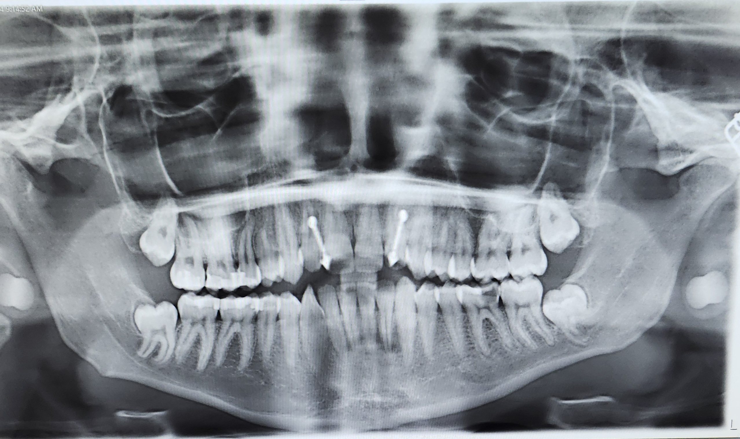 xray of my teeth